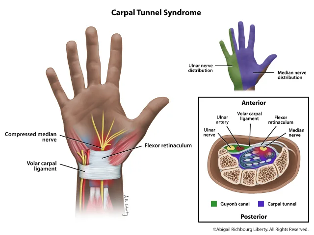 Illustration showing the cause of carpal tunnel syndrome and areas of the hand innervated by the medial and ulnar nerves. 