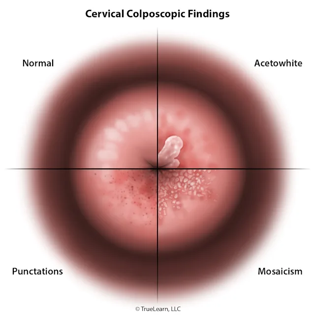 Illustration comparing a normal cervix with acetowhite, mosaicism, and punctations. Created as an employee of TrueLearn, LLC. Image used with permission. 