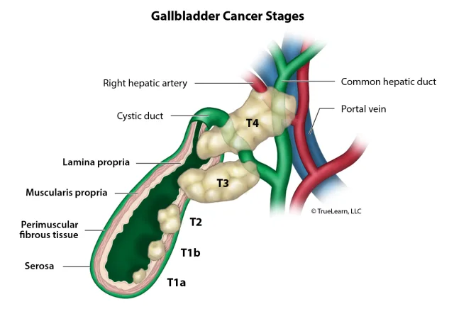 Illustration showing the anatomy associated with different stages of gallbladder cancer. Created as an employee of TrueLearn, LLC. Image used with permission. 