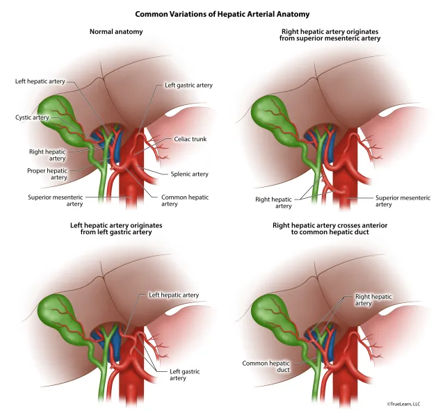 Illustration showing typical placement of hepatic arteries, along with the 3 most common variations. Created as an employee of TrueLearn, LLC. Image used with permission.  