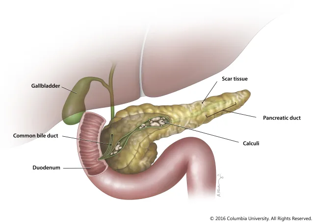 Illustration of chronic pancreatitis and surrounding anatomy for the Pancreas Center at Columbia University Medical Center. Created as an employee of the Columbia University Medical Center Department of Surgery. Image used with permission from Columbia University. 