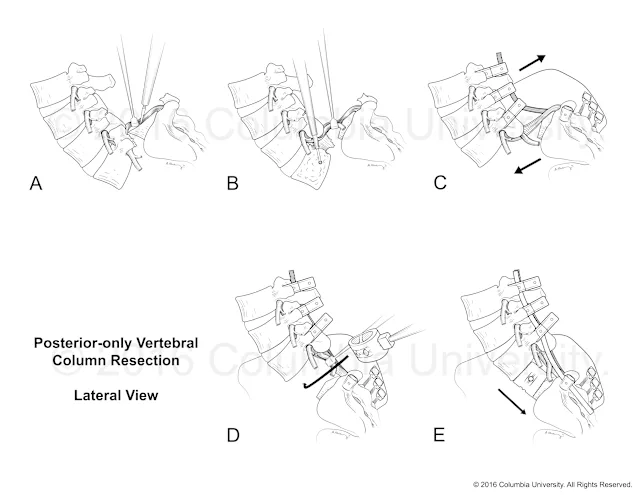 Illustration created to accompany a paper on posterior-only vertebral column resection by Lawrence Lenke, MD. Created as an employee of the Columbia University Medical Center Department of Surgery. Image used with permission from Columbia University. 