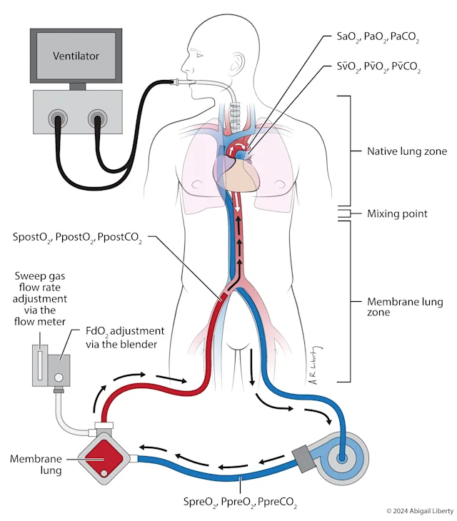 Line illustration with spot color showing configuration used in dual circulation VA ECMO. Created for Jenelle Badulak, MD and the Department of Emergency Medicine at University of Washington Medical Center