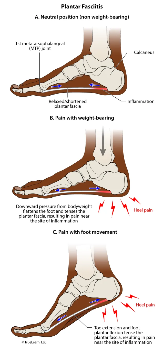 Illustration showing why pain occurs with plantar fasciitis during weight-bearing/foot movement. Created as an employee of TrueLearn, LLC. Image used with permission. 