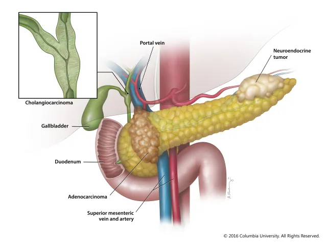 Patient education illustration showing common tumor locations in the pancreas and gallbladder for the Pancreas Center at Columbia University Medical Center. Created as an employee of the Columbia University Medical Center Department of Surgery. Image used with permission from Columbia University. 