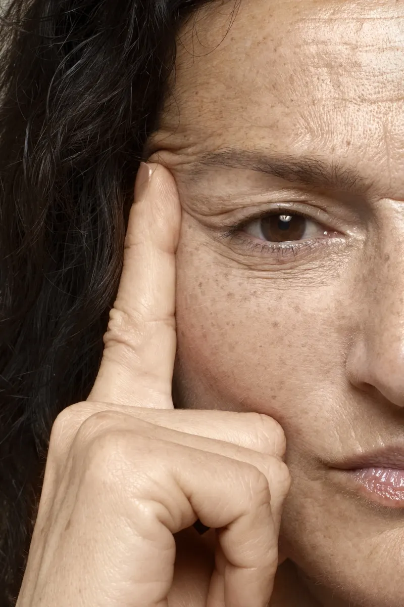 hyperpigmentation menopause