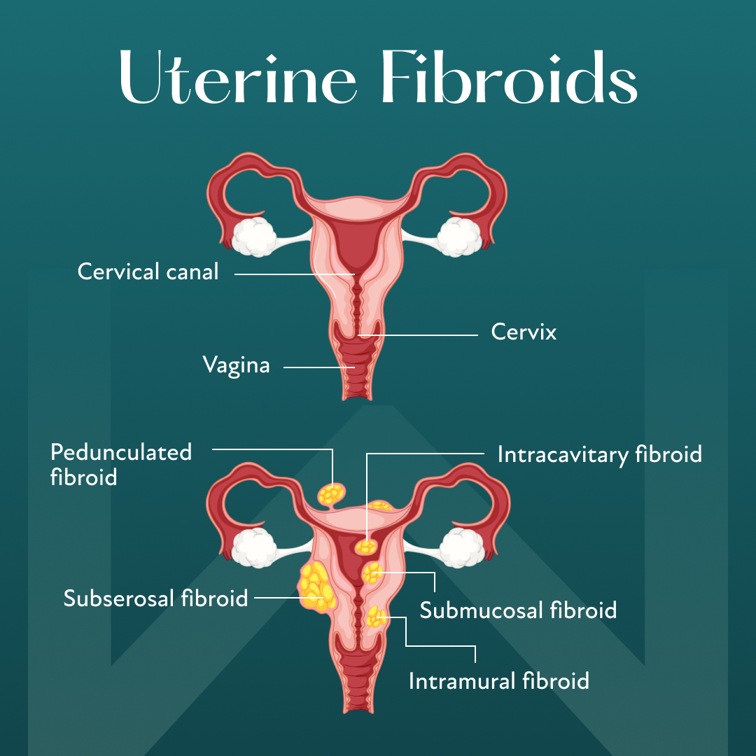 Uterine fibroids during menopause