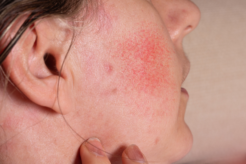 rosacea in menopause