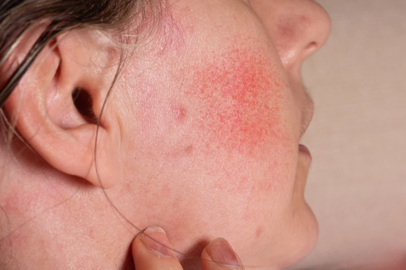rosacea in menopause