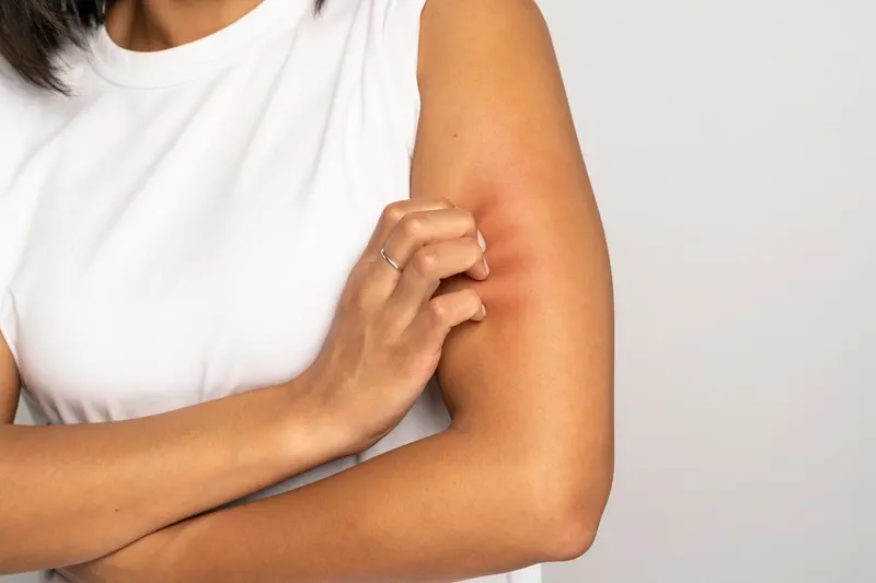 histamine intolerance