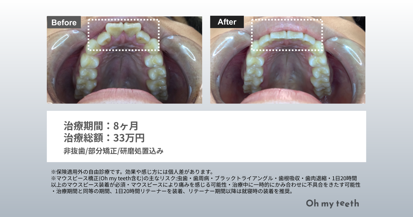 部分矯正 出っ歯 症例画像③
