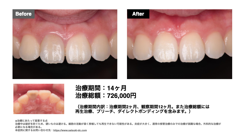 歯髄治療：症例写真