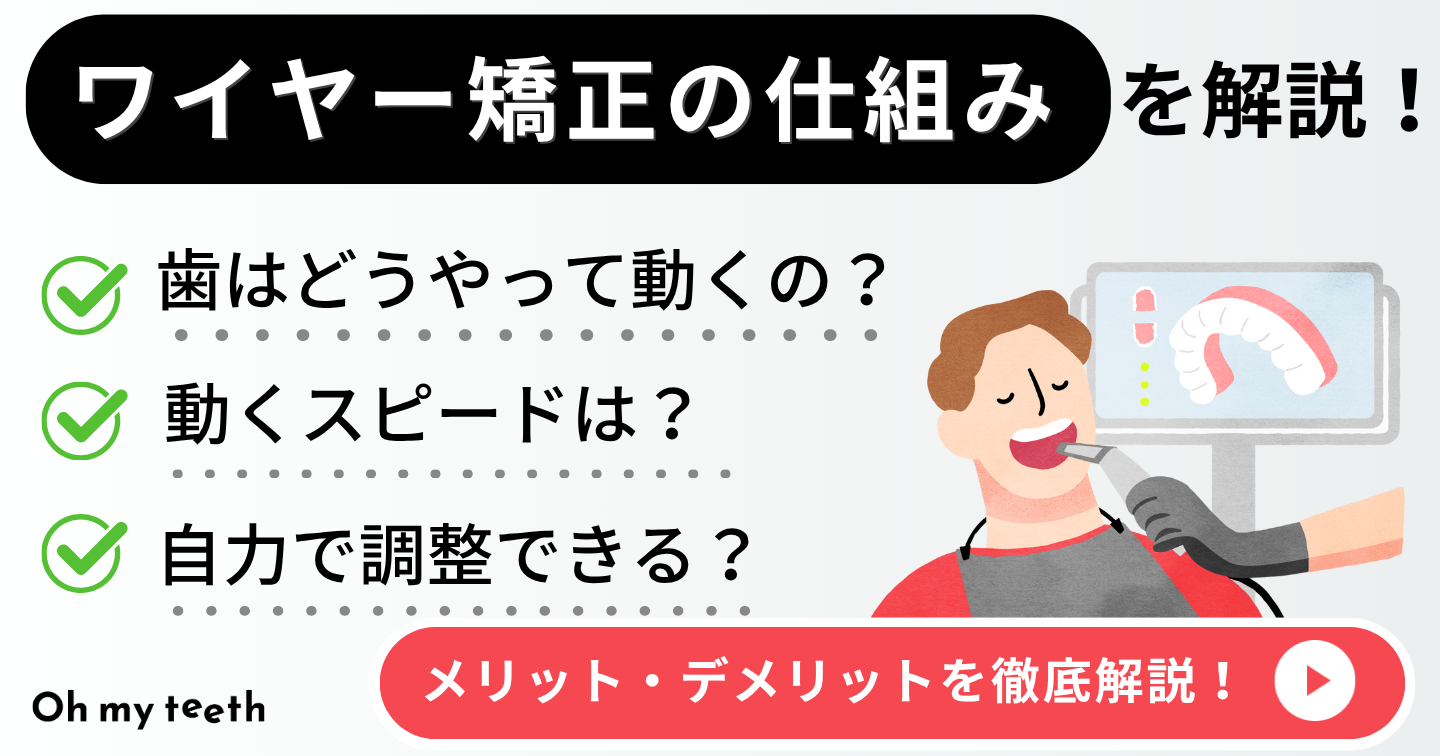 ワイヤー矯正　仕組み　アイキャッチ