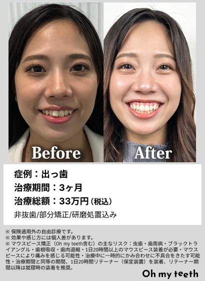 全顔BA・出っ歯