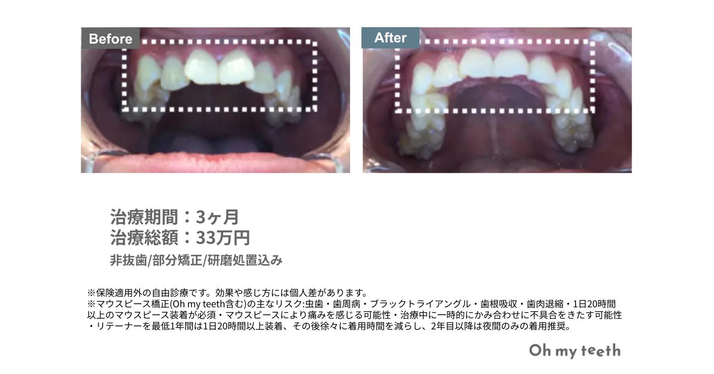 叢生・ガタガタの歯並びの症例写真