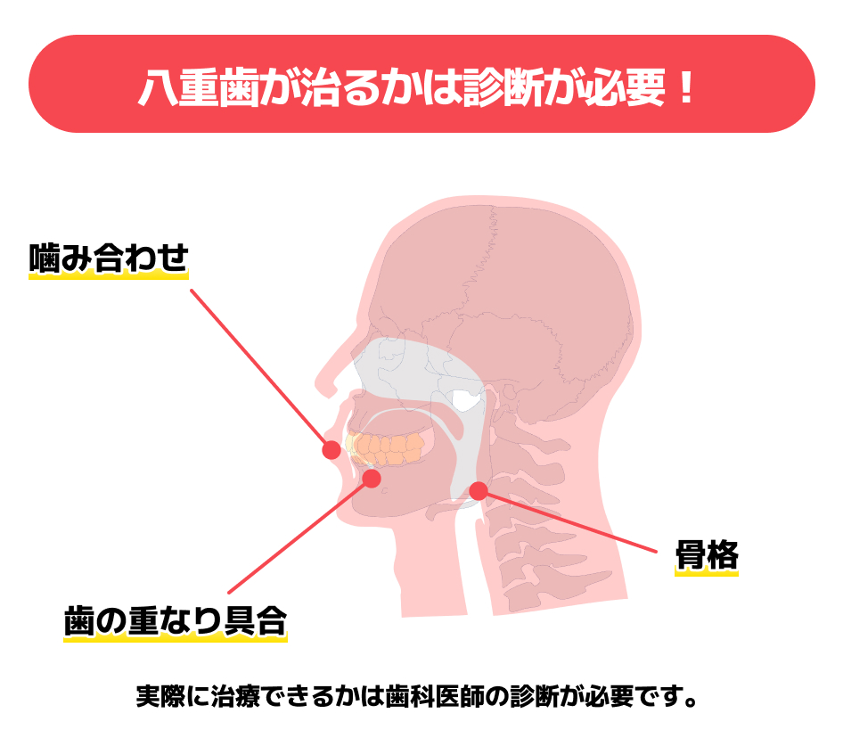 八重歯３
