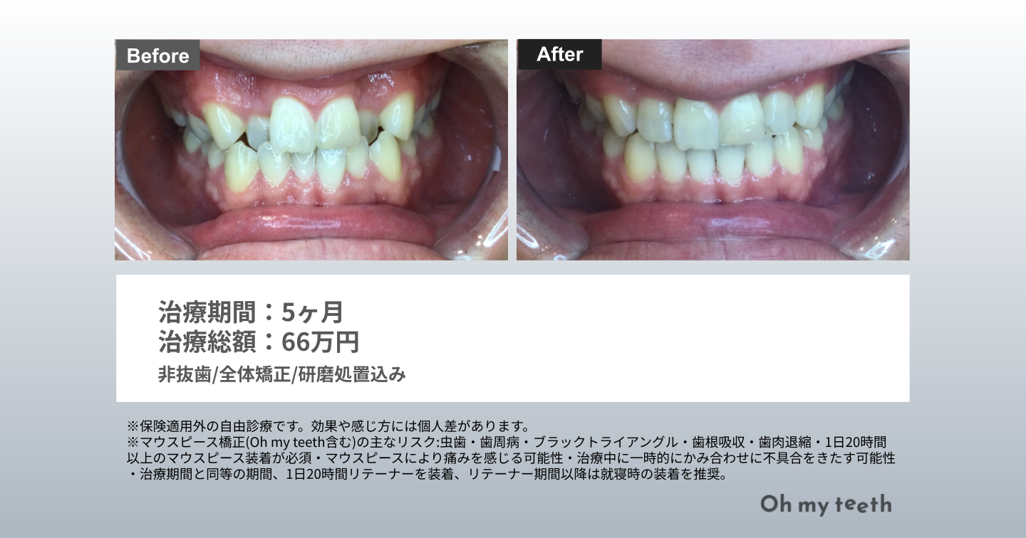 八重歯症例Pro