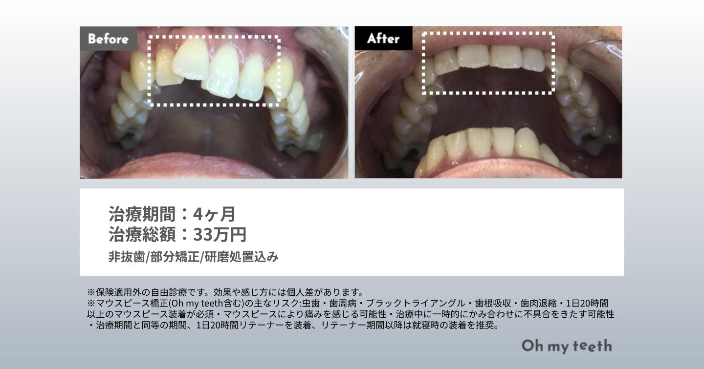 48歳・男性・Basic・4カ月症例（叢生、出っ歯）