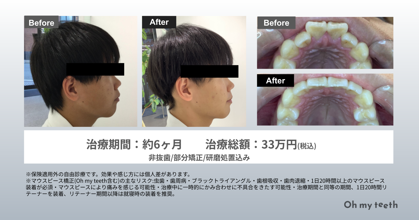 歯 列 矯正 顔 の 変化 写真
