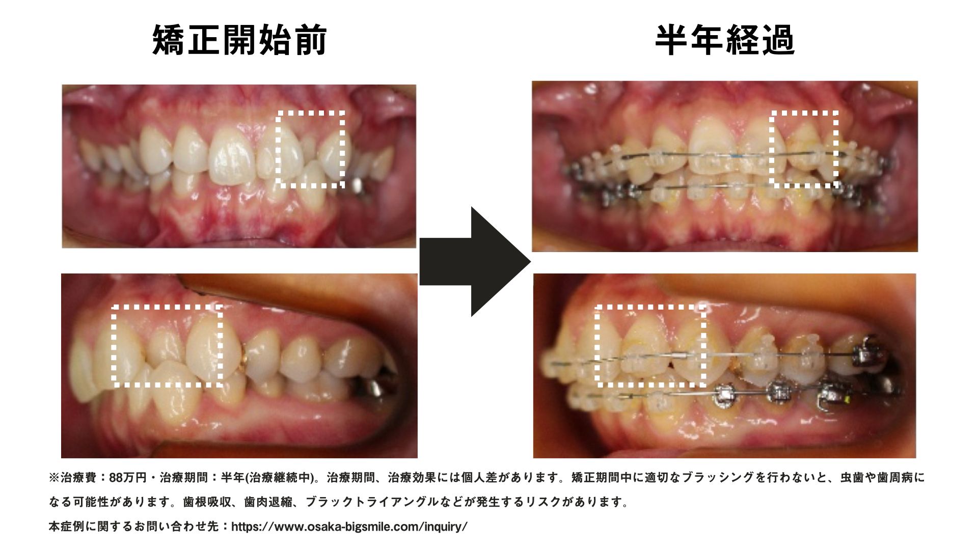 インシグニア矯正の症例(交叉咬合)