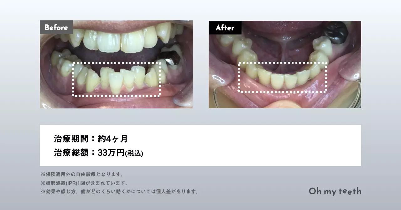 下の歯だけの矯正費用・種類・難しい症例を徹底解説！