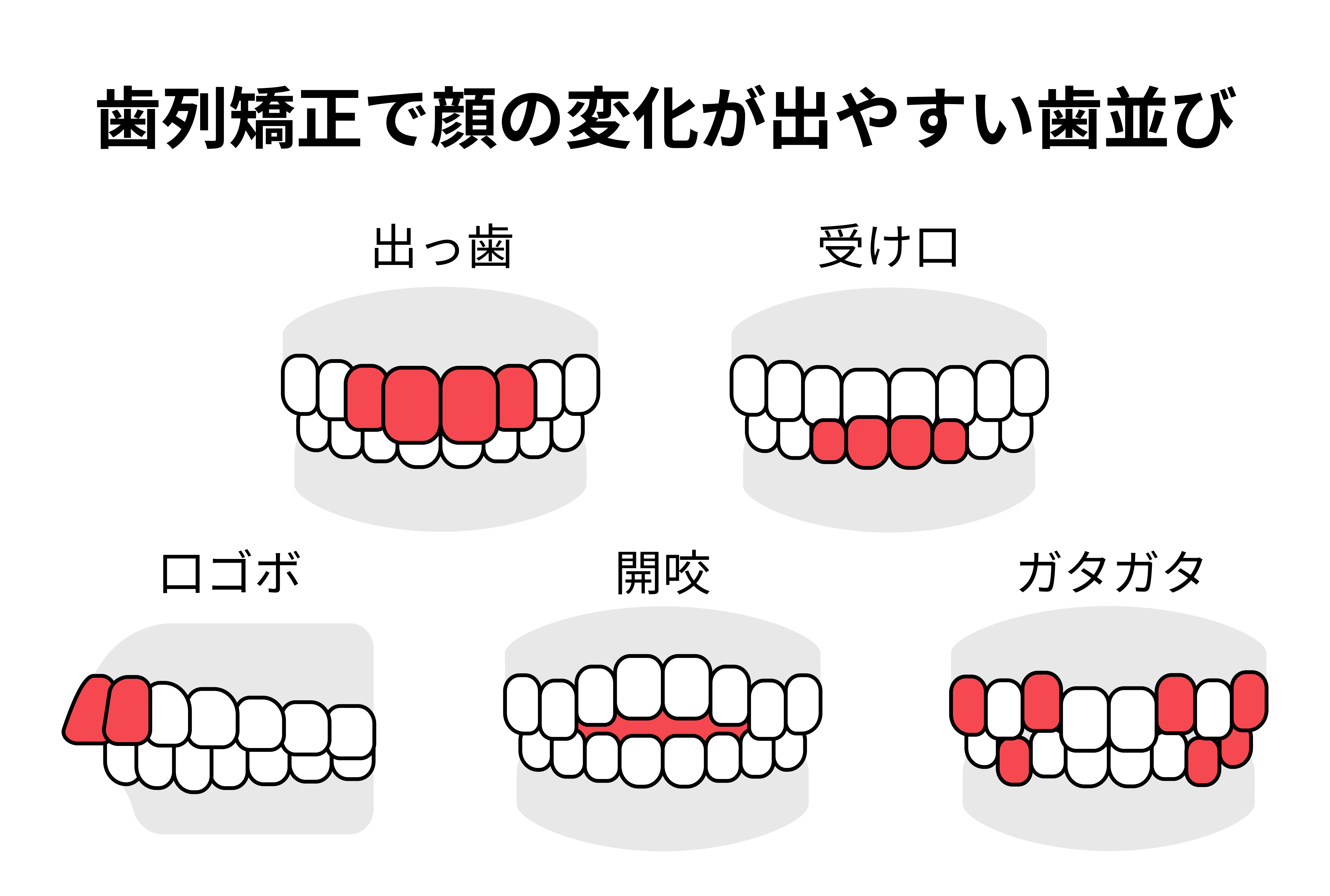 歯列矯正で顔の変化が出やすい歯並びとは？