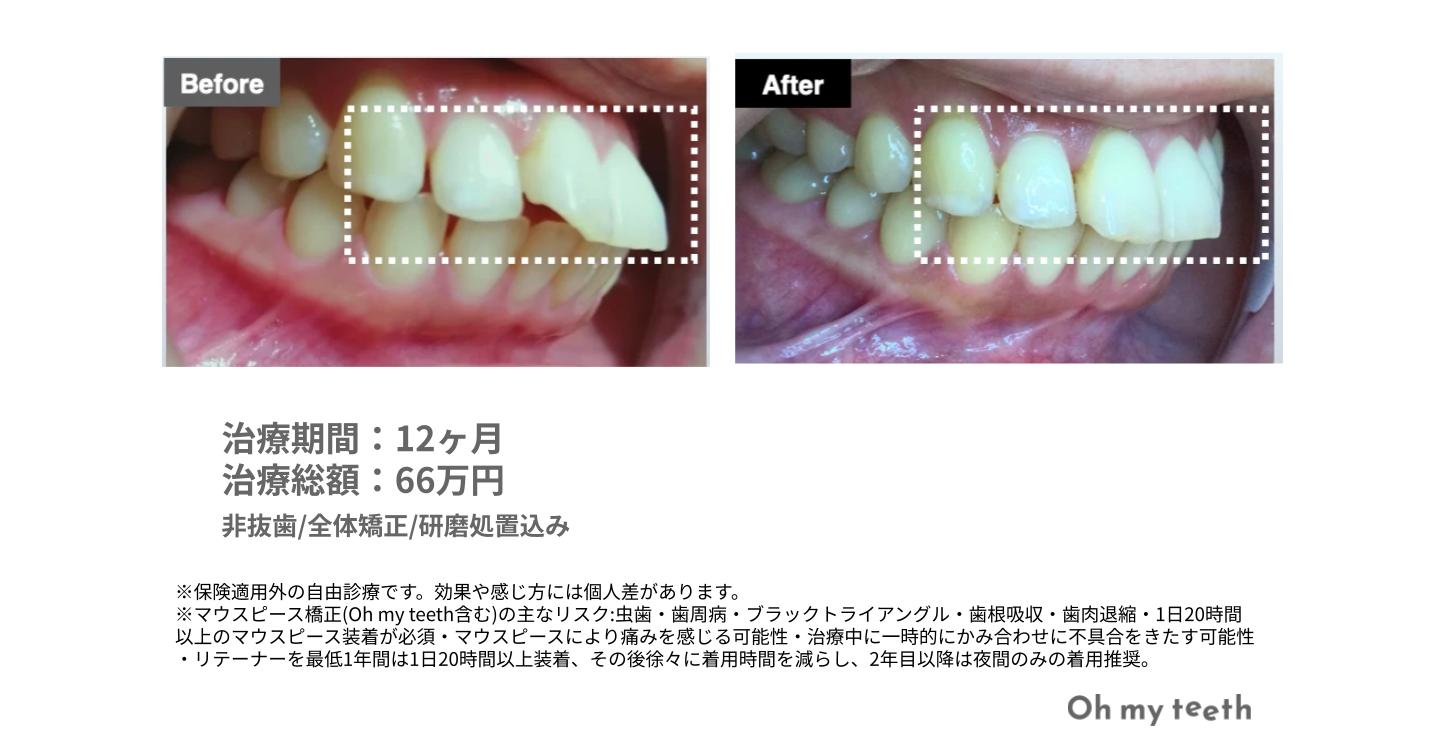 どこからが出っ歯?重度の基準とセルフチェック方法を解説