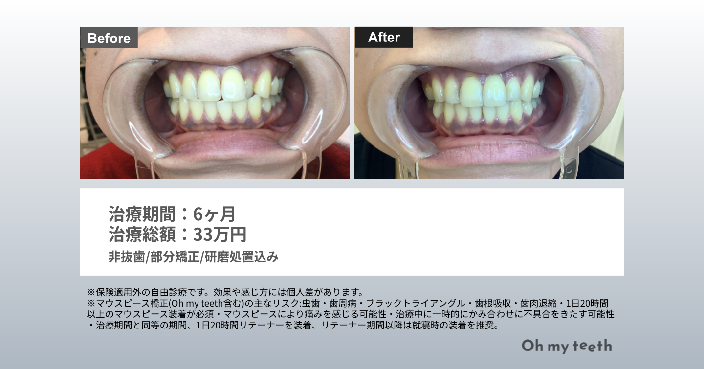 42歳・女性・Basic・6ヶ月症例（八重歯）
