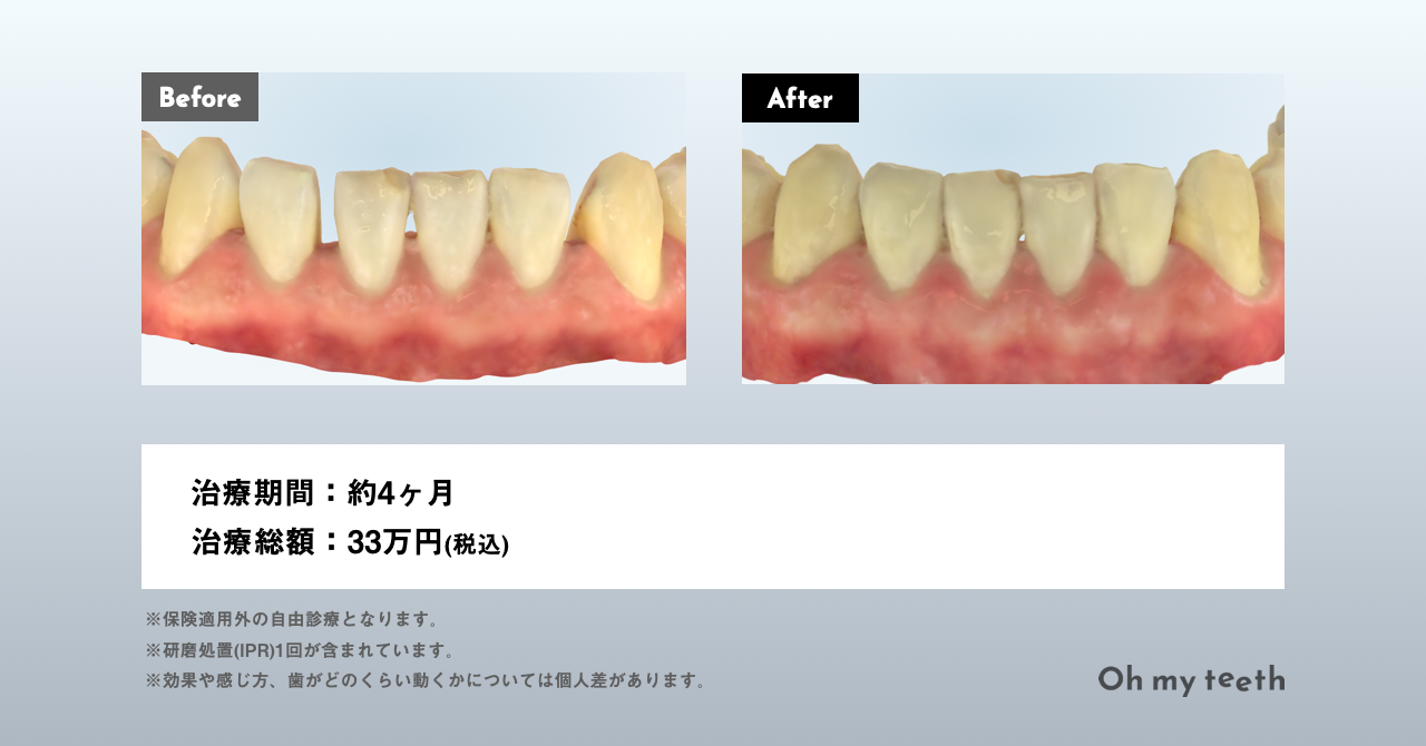 マウスピース矯正中の運動はOK？制限や注意点を解説