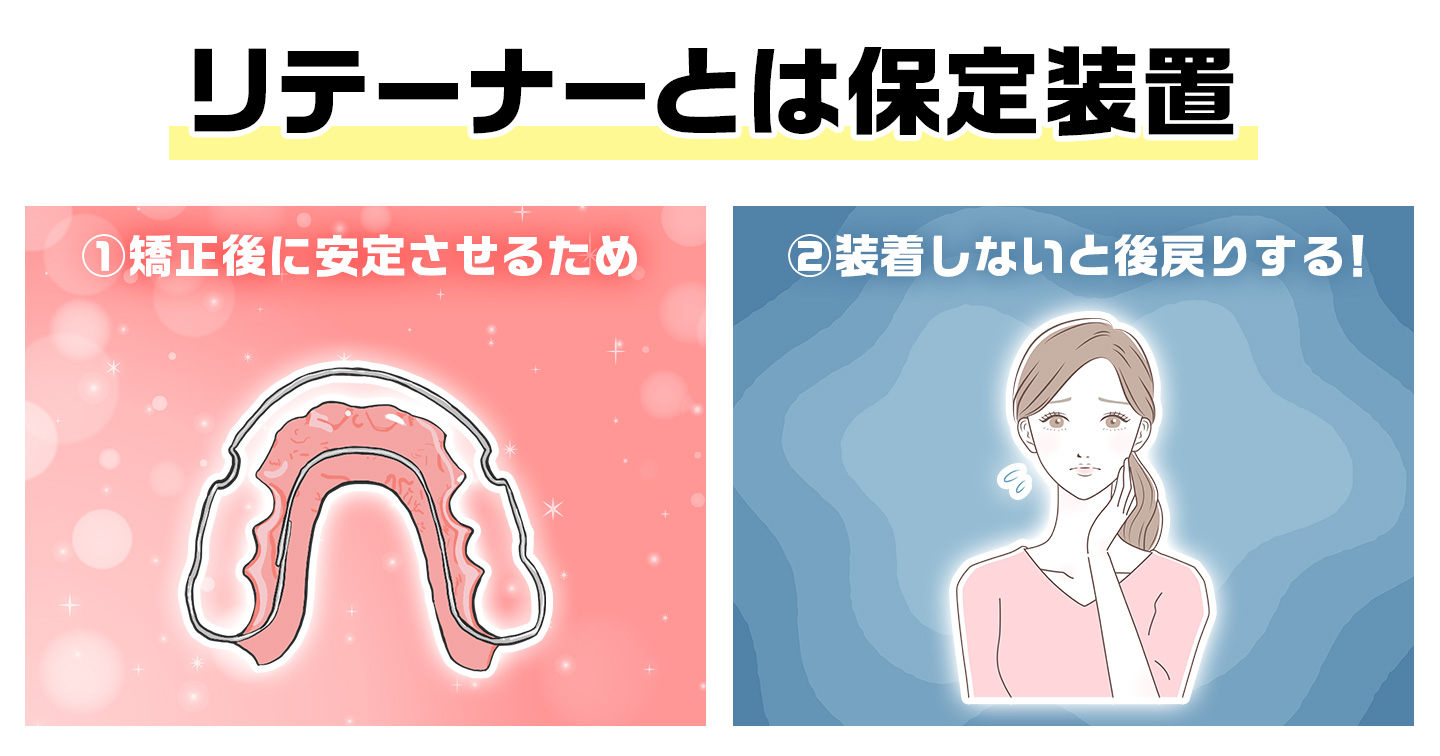リテーナーとは保定装置