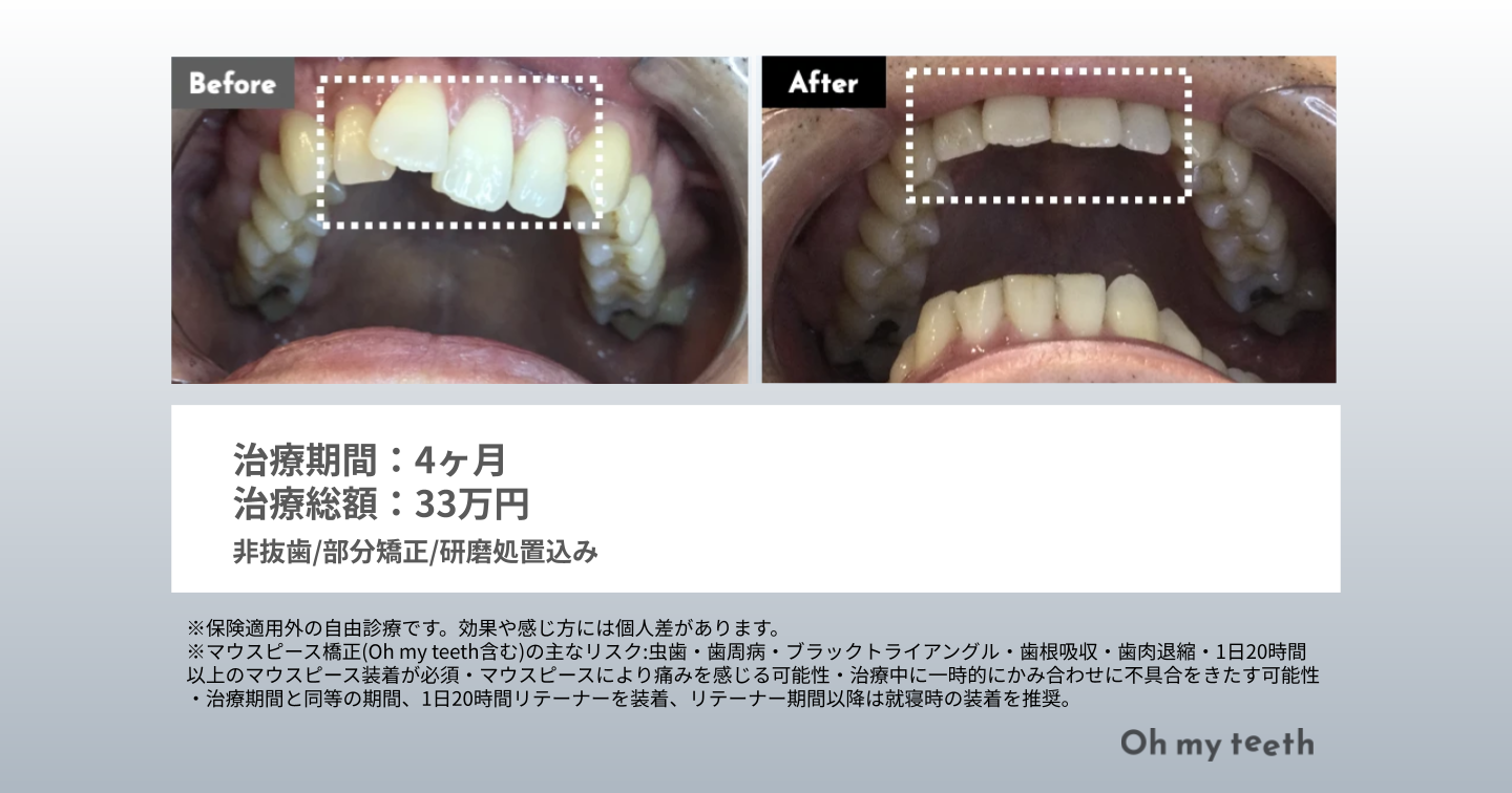 捻転歯 症例写真(ねじれ4ヶ月)