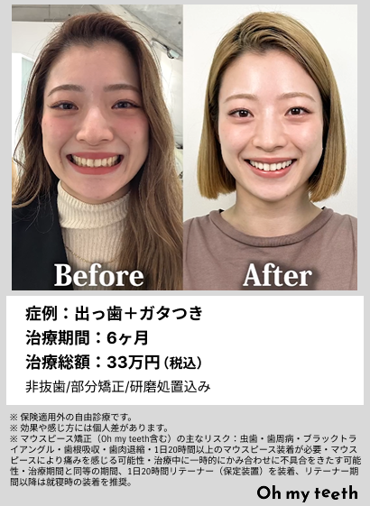 出っ歯は矯正で治せる?改善した実例を写真付きで解説