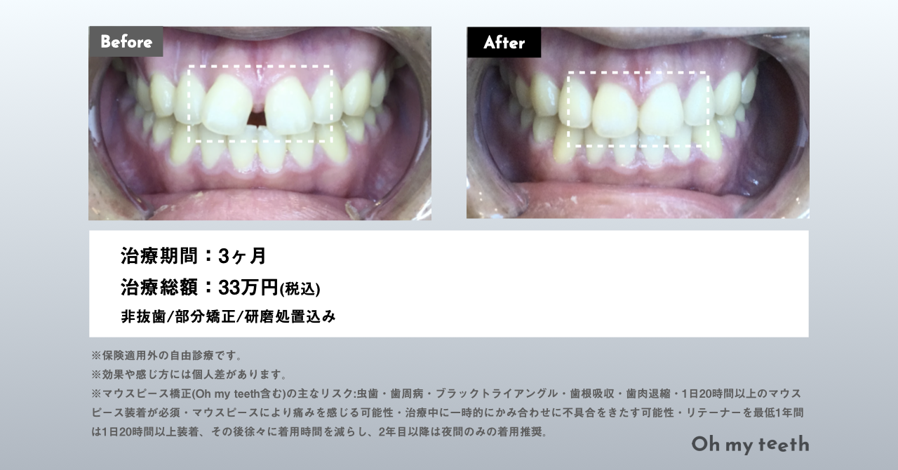 Oh my teethマウスピース矯正の症例画像(すきっ歯)