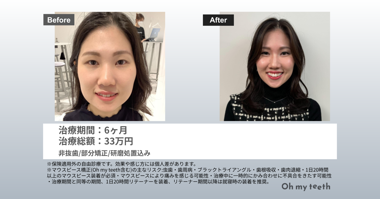 八重歯 矯正 顔 変わる