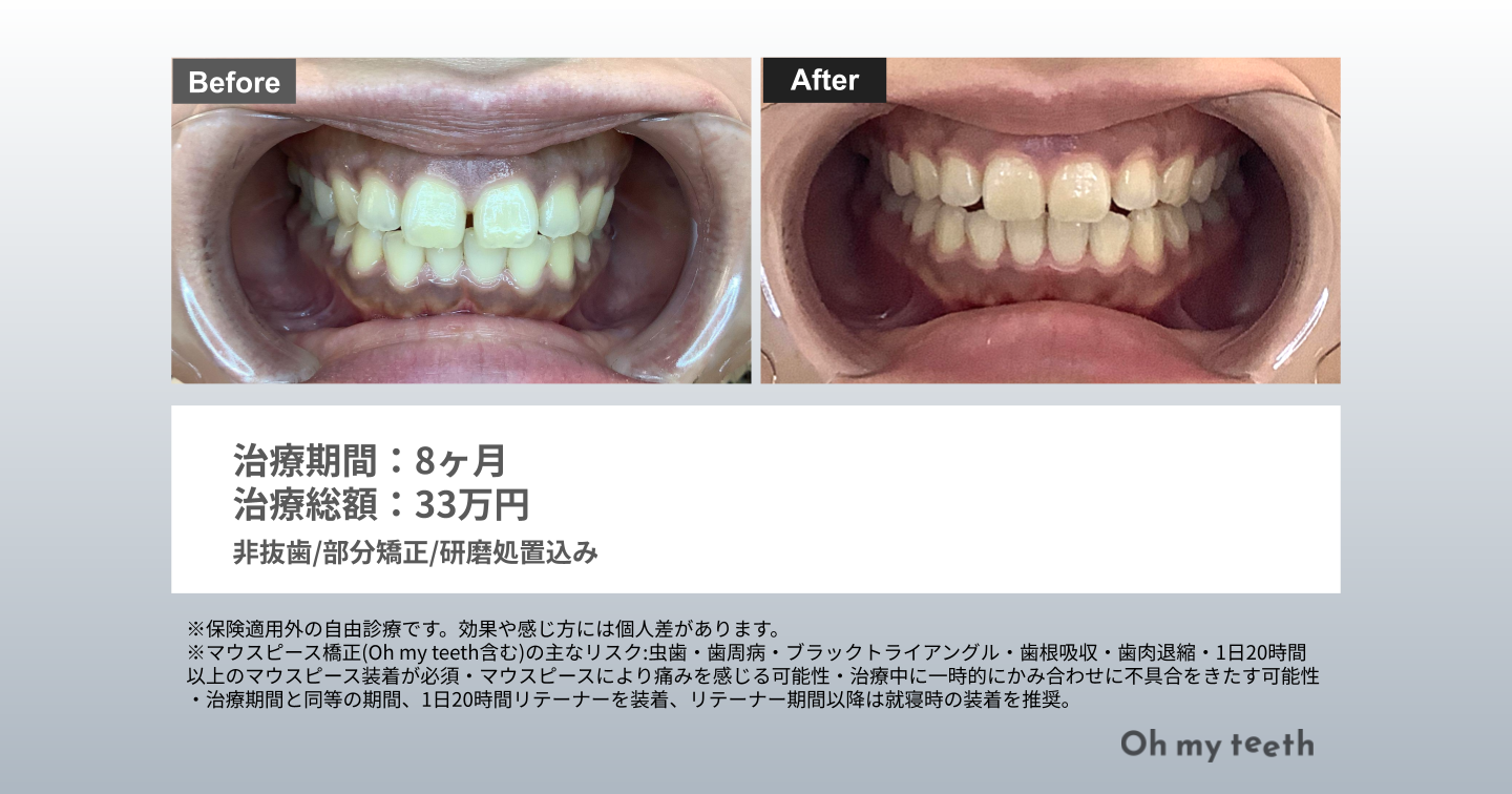 41歳・女性・Basic・8ヶ月症例（すきっ歯）