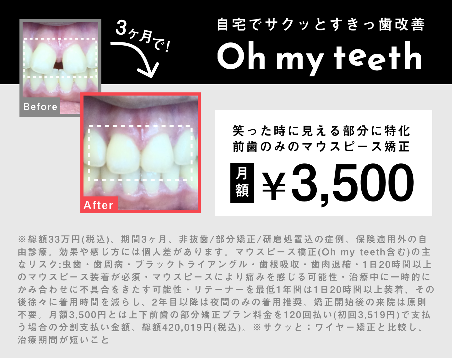 すきっ歯改善症例カバー