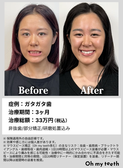OrthoPulse Gen 2.0 歯の矯正促進器具 光加速矯正装置オルソパルスの 