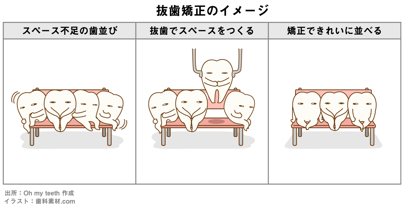 抜歯矯正のイメージイラスト