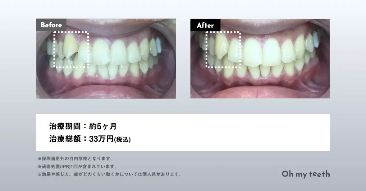 Oh my teethマウスピース矯正の症例画像(八重歯)