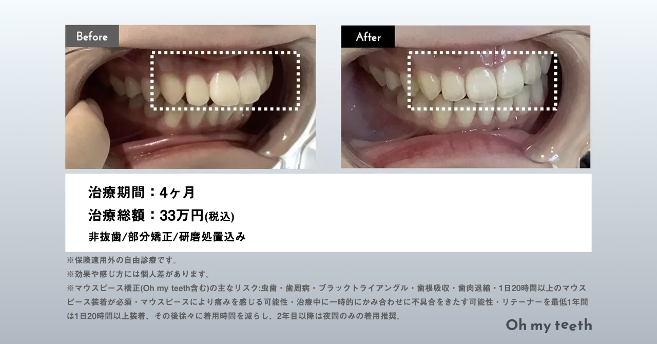 Oh my teeth 症例 (出っ歯・女性・大学2年生)