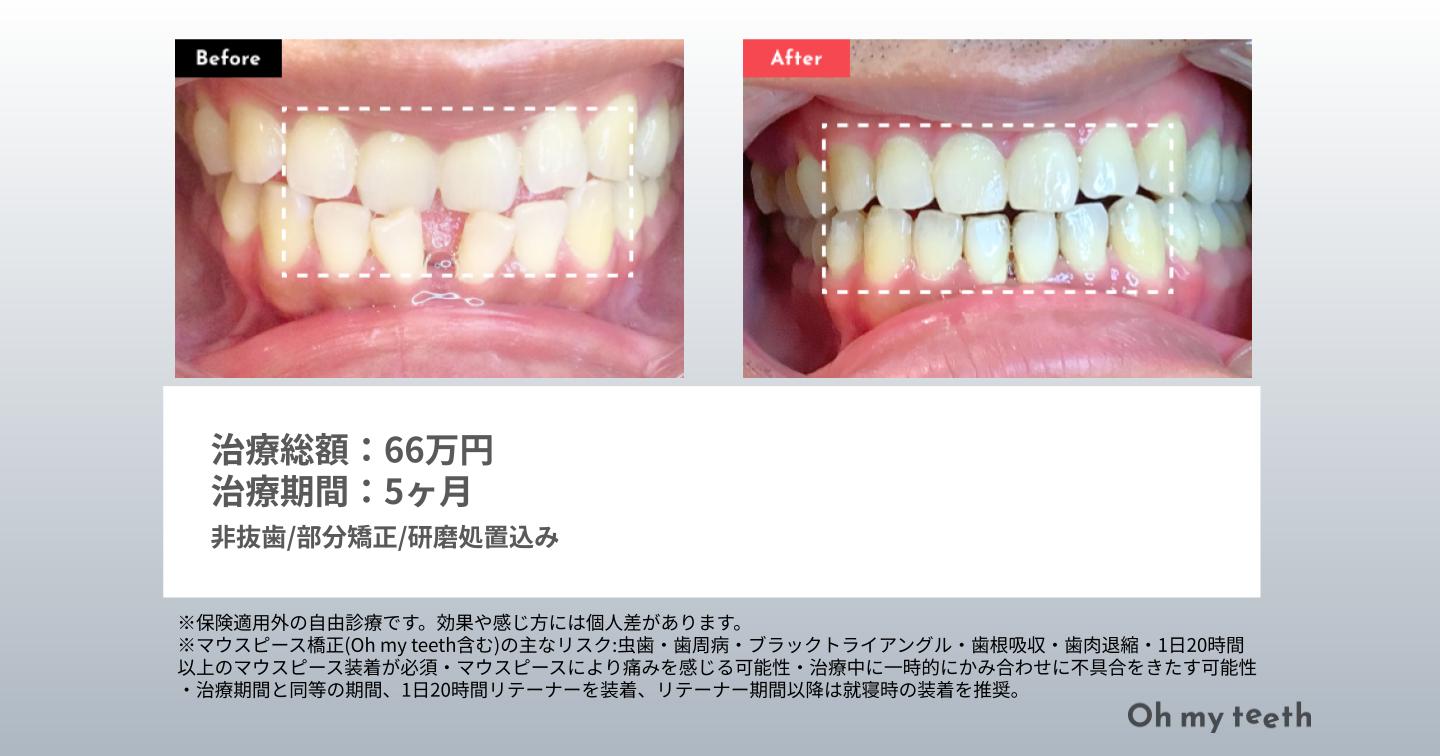 Oh my teethProプランのすきっ歯の症例