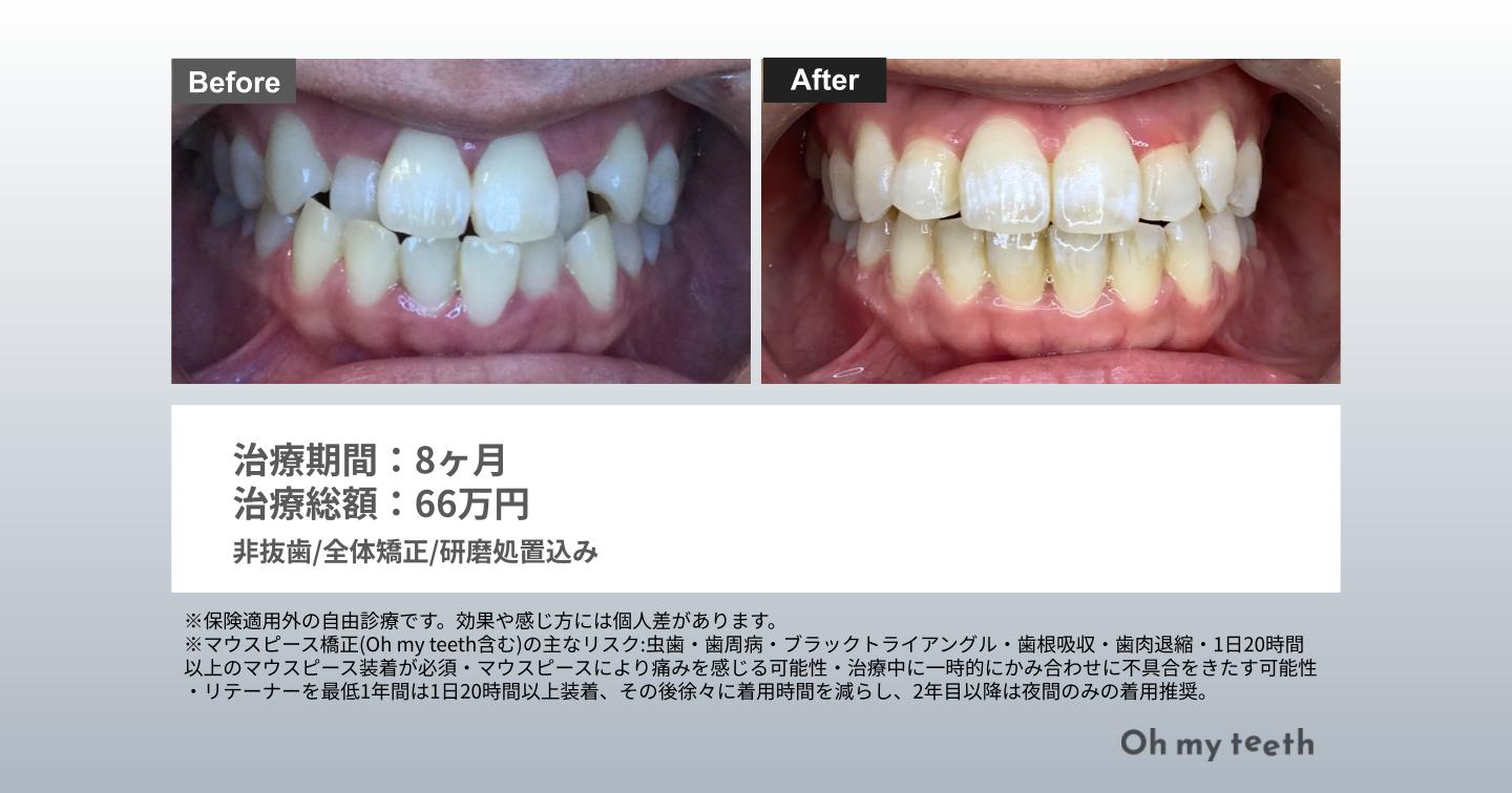 マウスピース矯正 Oh my teethの八重歯の症例(全体矯正)