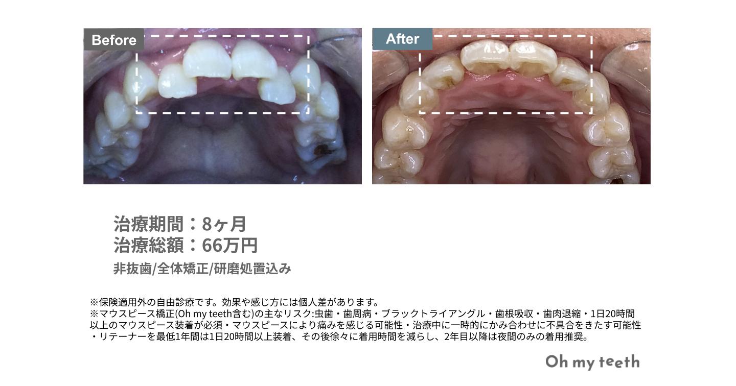 叢生・ガタガタの歯並びの症例写真