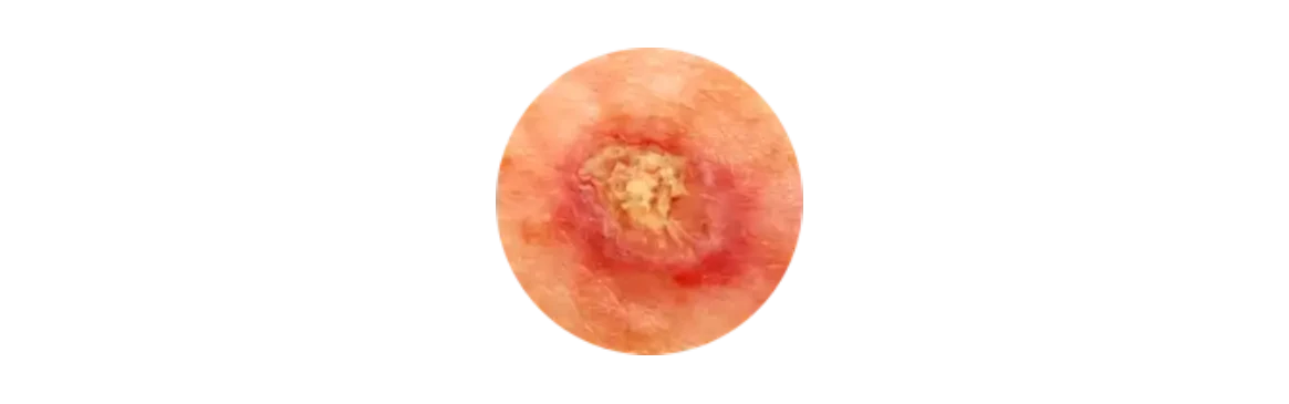 Squamous cell carcinoma