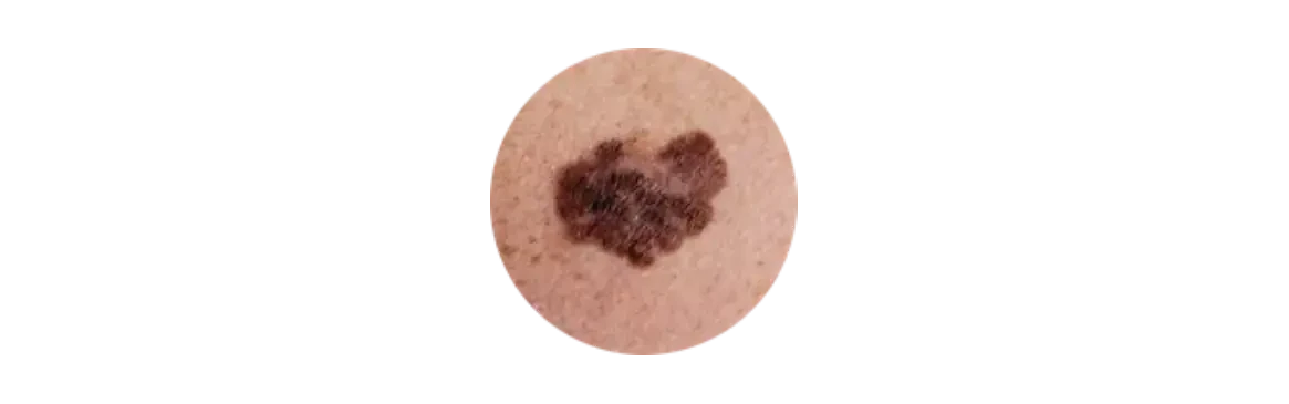 Melanoma