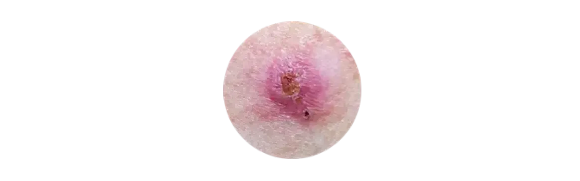 Basal cell carcinoma