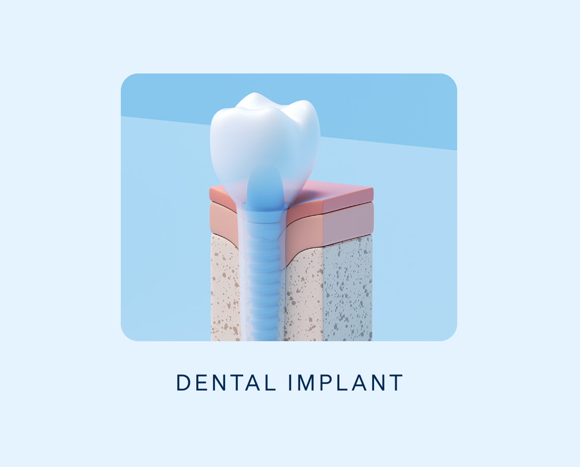 Illustration of a dental implant showing a tooth above an exposed cross-sectional view of gums and jaw with a screw implant embedded, set against a light blue background with a label reading "DENTAL IMPLANT."