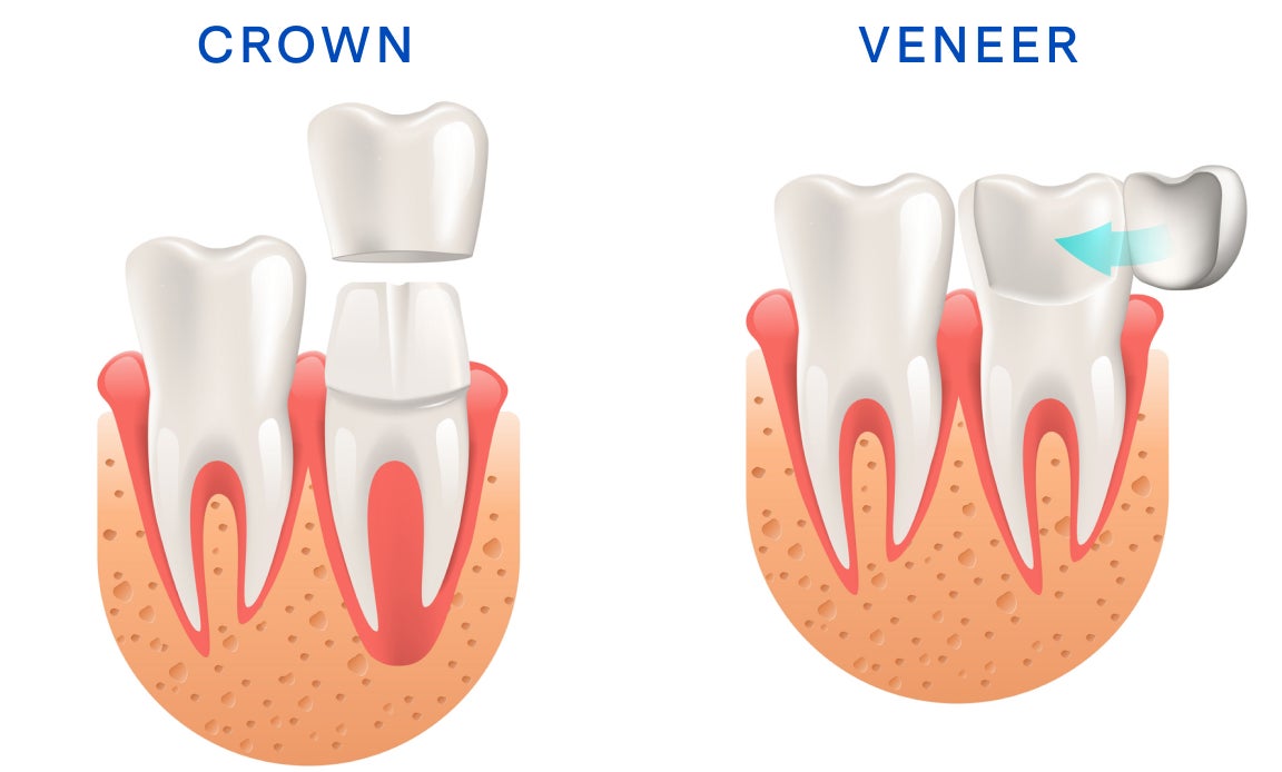 An illustration comparing the functionality of both a dental crown and a veneer, showing how each work and are placed on the tooth.