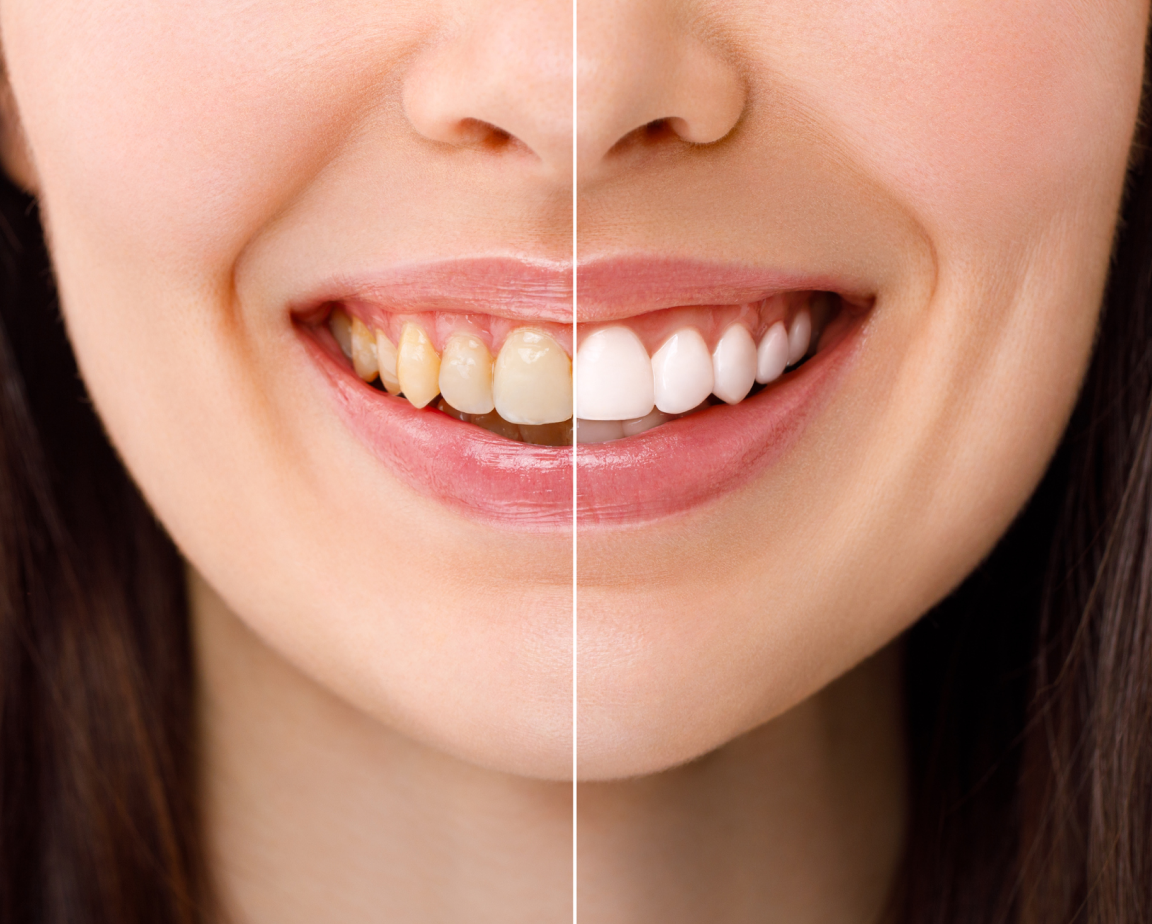 Close-up of a woman's smile showing a comparison of teeth before and after teeth whitening; the left side of the image displays yellow teeth, and the right side shows bright, white teeth.