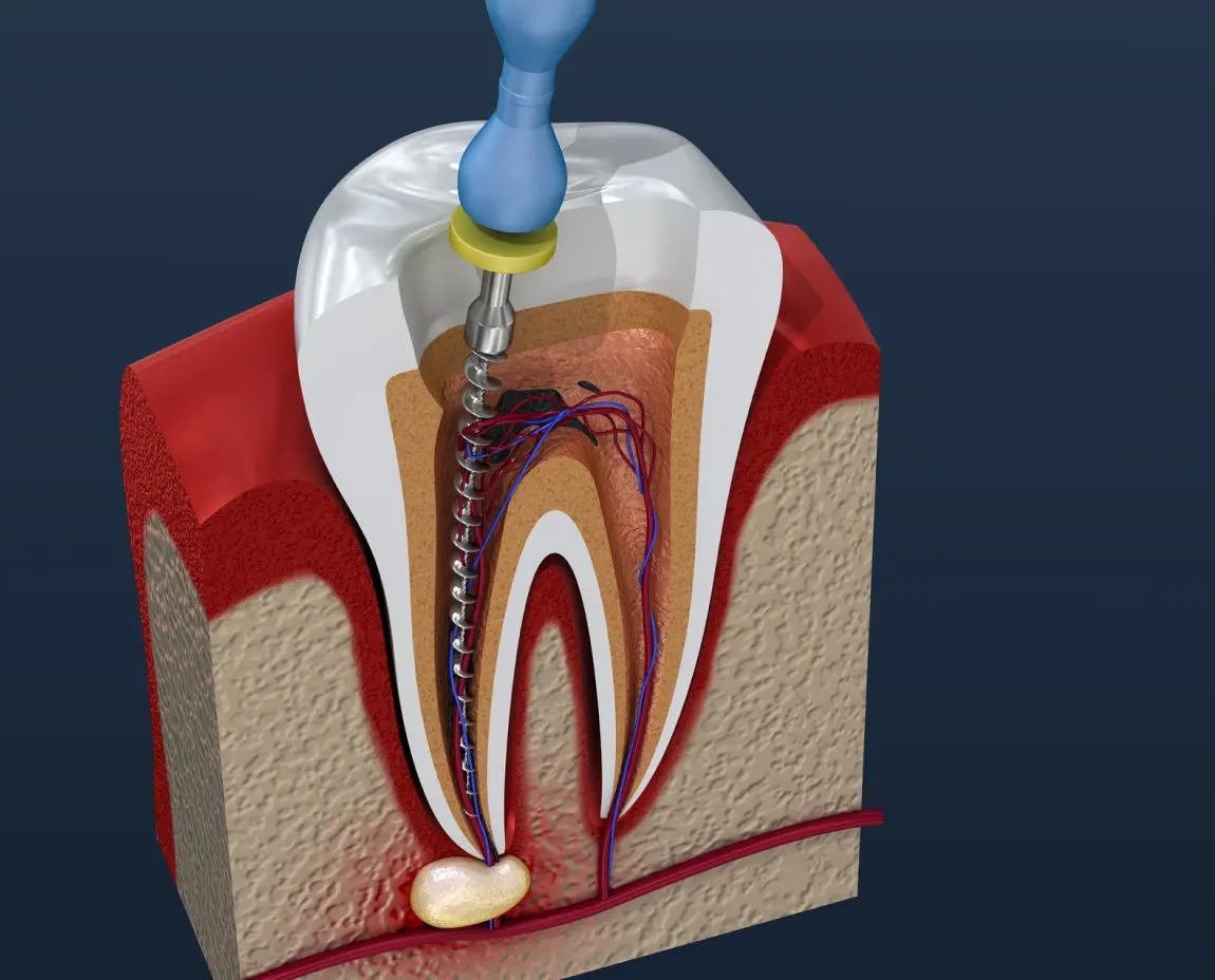 Detailed 3D illustration of a tooth undergoing a root canal procedure, showing the internal structure, including nerves and pulp, with a dental instrument cleaning the canal.